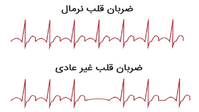 بیماری قلبی آریتمی چیست؟ | متخصص قلب اصفهان