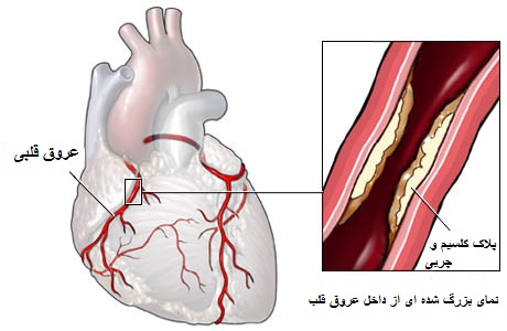 کاهش جریان خون در عروق کرونری | متخصص قلب اصفهان