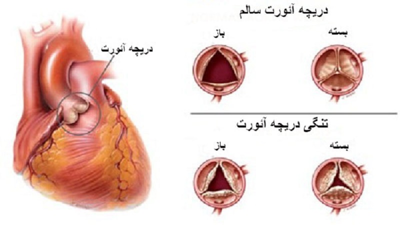 نارسایی دریچه آئورت چیست؟ | علت و علائم | متخصص قلب اصفهان