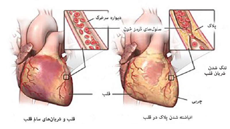 علائم و علل آنژین قلبی کدامند | متخصص قلب اصفهان