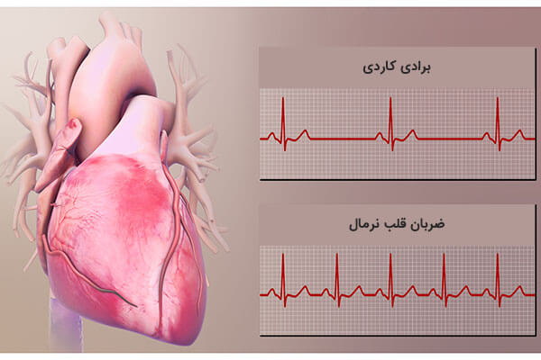 برادی کاردی چیست؟ | متخصص قلب اصفهان