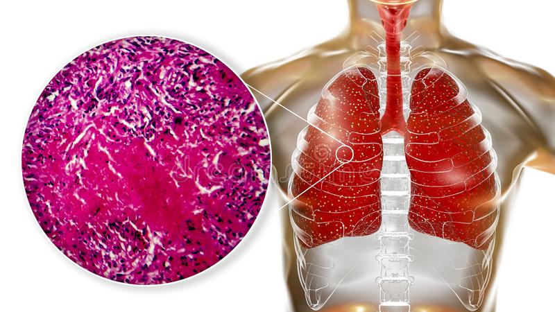 نحوه تشخیص گرانولوماتوز | متخصص قلب اصفهان