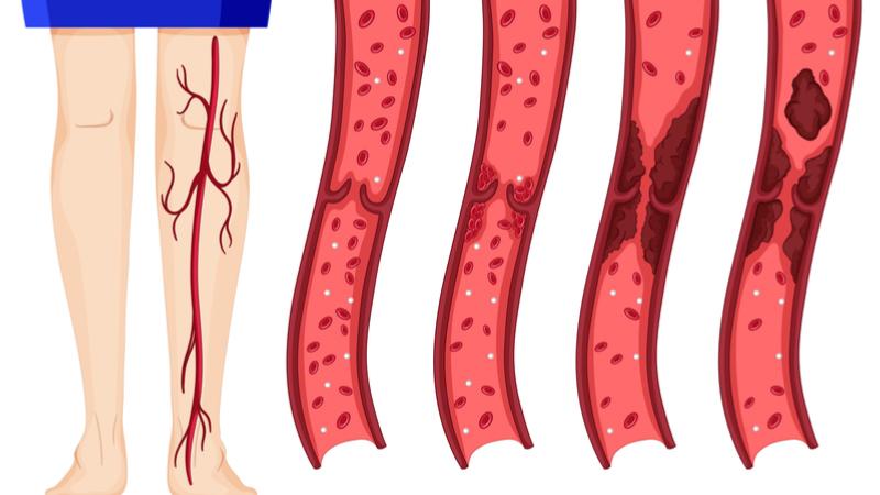 روش های درمانی واریس طنابی | متخصص قلب اصفهان