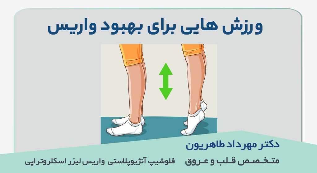 درمان واریس پا با ورزش میتواند در کنار درمان های دیگر از پیشرفت این بیماری جلوگیری کند.|متخصص واریس اصفهان