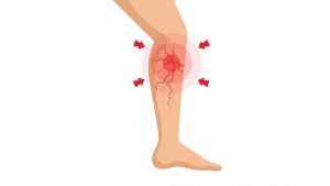 خونریزی ناشی از واریس | دکتر مهرداد طاهریون بهترین متخصص واریس اصفهان