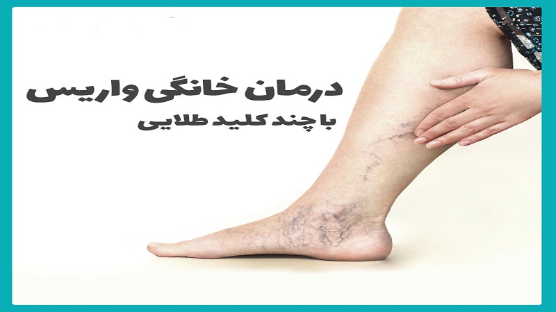 چگونه می توان خارش رگ های واریسی را در خانه مدیریت کرد؟|بهترین متخصص واریس اصفهان | دکتر مهرداد طاهریون