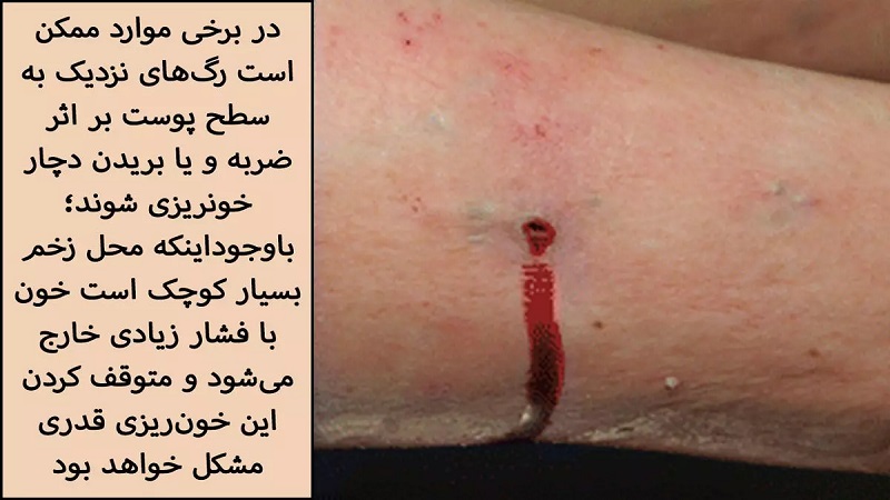 خونریزی ناشی از واریس | دکتر مهرداد طاهریون بهترین متخصص واریس اصفهان