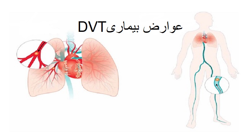 DVTعوارض بیماری | دکتر مهرداد طاهریون بهترین متخصص واریس اصفهان