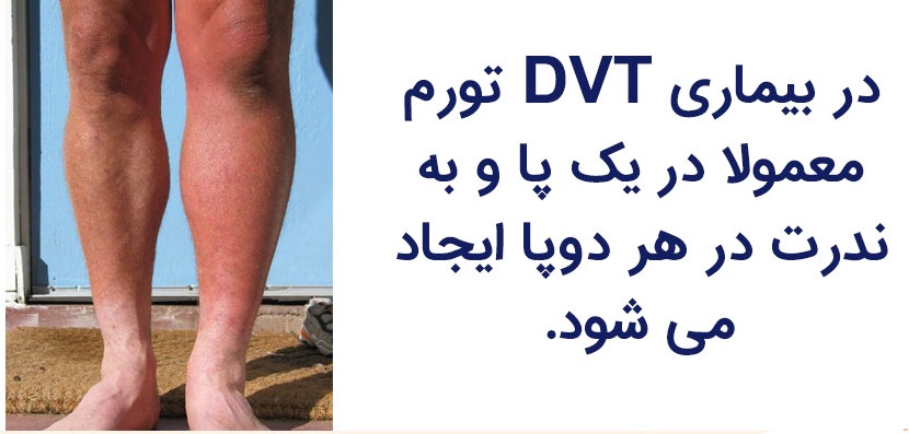 علائم بیماری DVT|دکتر مهرداد طاهریون بهترین متخصص واریس اصفهان