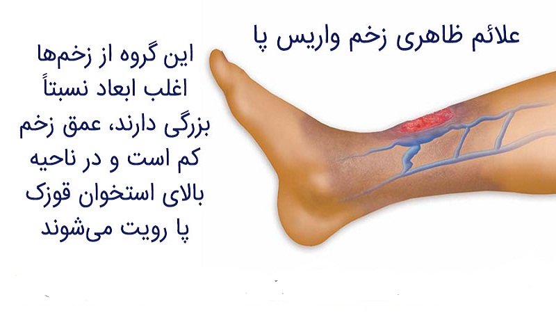 علائم زخم واریس | دکتر مهرداد طاهریون بهترین متخصص واریس اصفهان