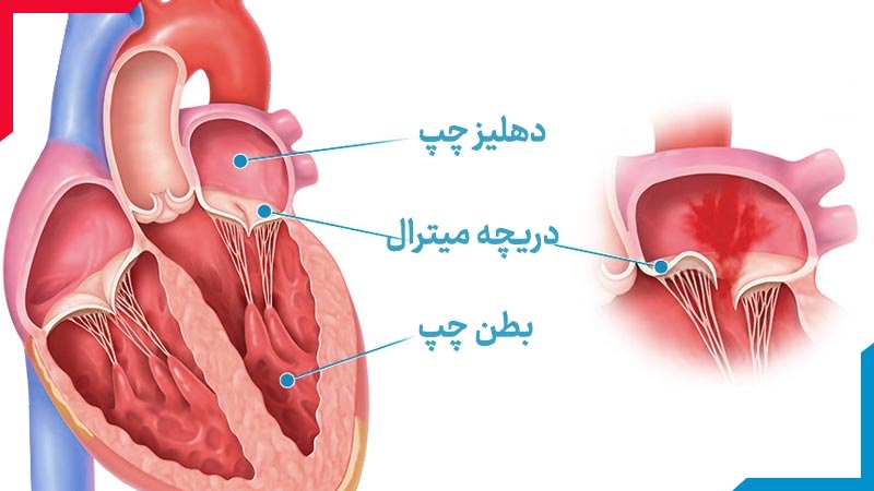 پرولاپس یا ناهنجاری دريچه ميترال | بهترین متخصص واریس اصفهان - متخصص قلب اصفهان