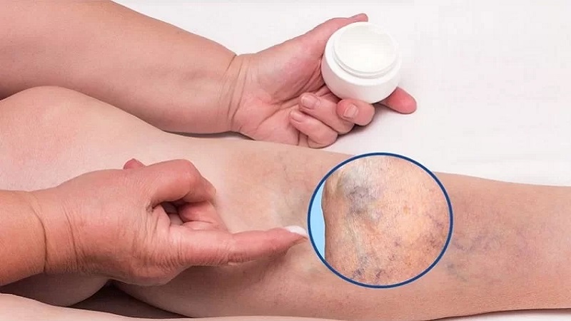 پماد واریس چیست؟ | بهترین متخصص واریس اصفهان - متخصص قلب اصفهان