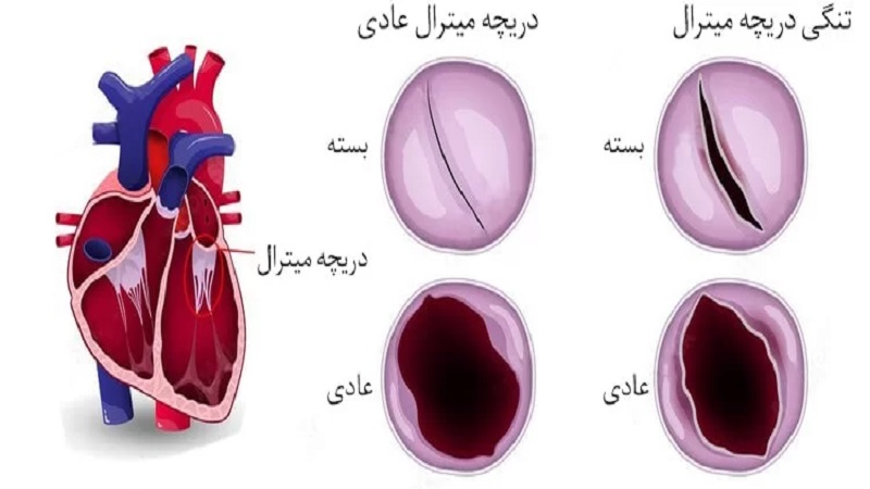 دریچه کمانی شکل (دریچه میترال) | بهترین متخصص واریس اصفهان - متخصص قلب اصفهان
