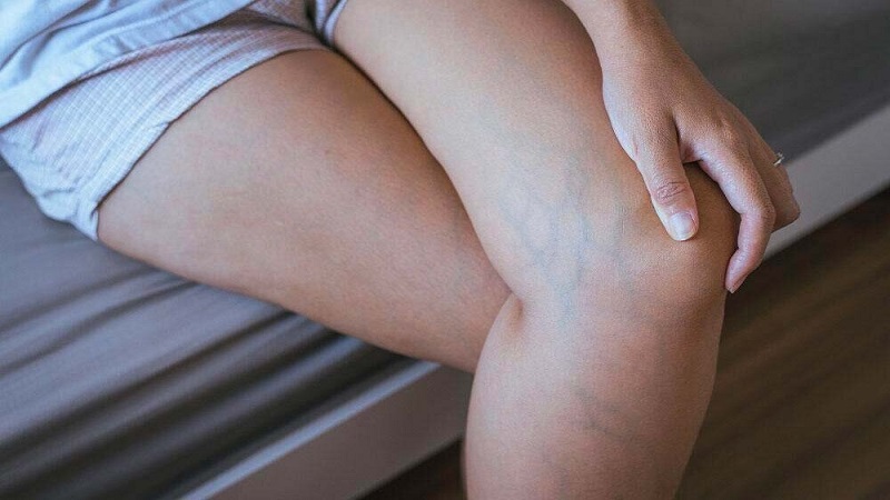 تاثیر واریس بر فشار خون | بهترین متخصص واریس اصفهان - متخصص قلب اصفهان