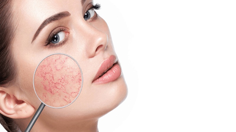 مویرگ‌های عنکبوتی | بهترین متخصص واریس اصفهان - متخصص قلب اصفهان