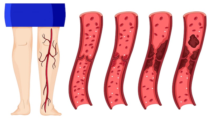 لخته‌های عمقی | بهترین متخصص واریس اصفهان - متخصص قلب اصفهان