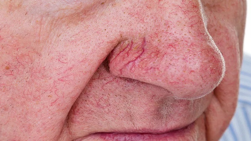 رگ‌های عنکبوتی صورت | دکتر طاهریون (بهترین متخصص واریس اصفهان - متخصص قلب اصفهان)
