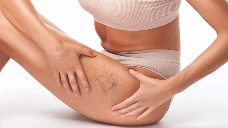 تاثیر دیابت بر روی واریس | دکتر مهرداد طاهریون (بهترین متخصص واریس اصفهان - متخصص قلب اصفهان)