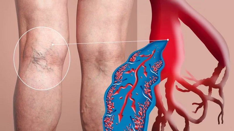 واریس و بیماری‌های کلیوی | بهترین متخصص واریس اصفهان - متخصص قلب اصفهان | دکتر مهرداد طاهریون