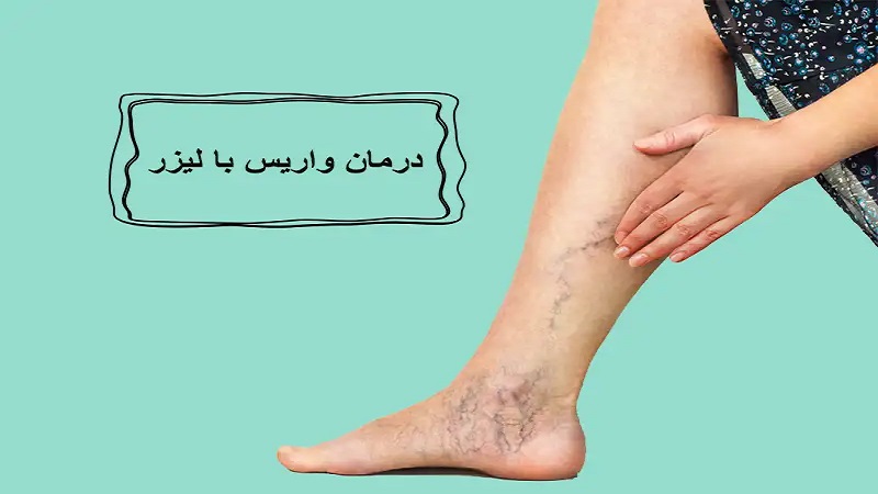 درمان واریس با لیزر | دکتر طاهریون (بهترین متخصص واریس اصفهان - متخصص قلب اصفهان)