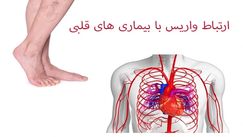 ارتباط بین واریس، اختلالات چربی خون و تاثیر آن بر سلامت قلب | دکتر مهرداد طاهریون (بهترین متخصص واریس اصفهان - متخصص قلب اصفهان)