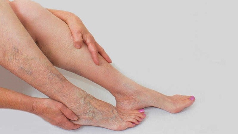 مکانیسم‌های تشکیل واریس | بهترین متخصص واریس اصفهان - متخصص قلب اصفهان | دکتر مهرداد طاهریون