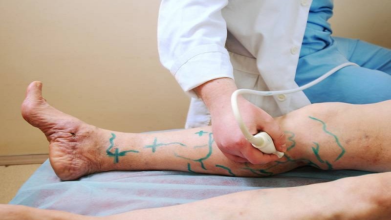 مقایسه روش‌های جراحی واریس |بهترین متخصص واریس اصفهان - متخصص قلب اصفهان | دکتر مهرداد طاهریون |بهترین متخصص قلب اصفهان