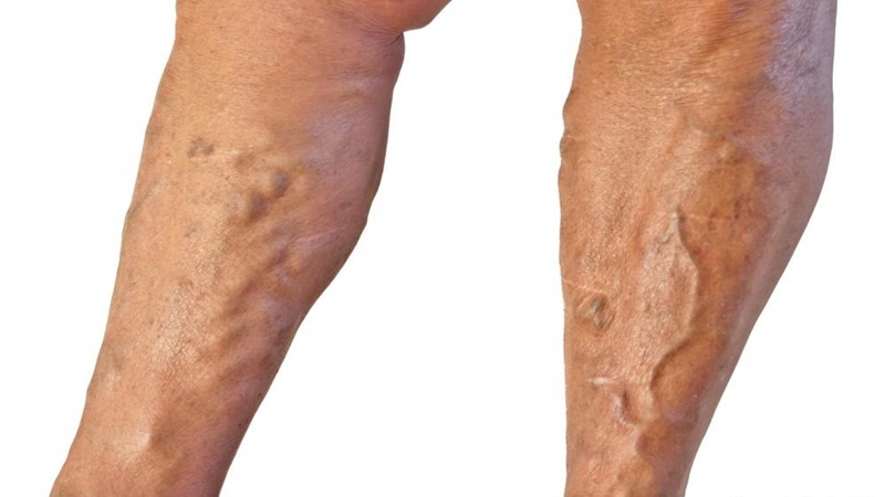 عوارض جانبی واریس untreated | دکتر مهرداد طاهریون (بهترین متخصص واریس اصفهان - متخصص قلب اصفهان)