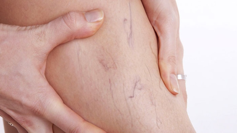 درمانهای خانگی برای واریس | بهترین متخصص واریس اصفهان - متخصص قلب اصفهان | دکتر مهرداد طاهریون