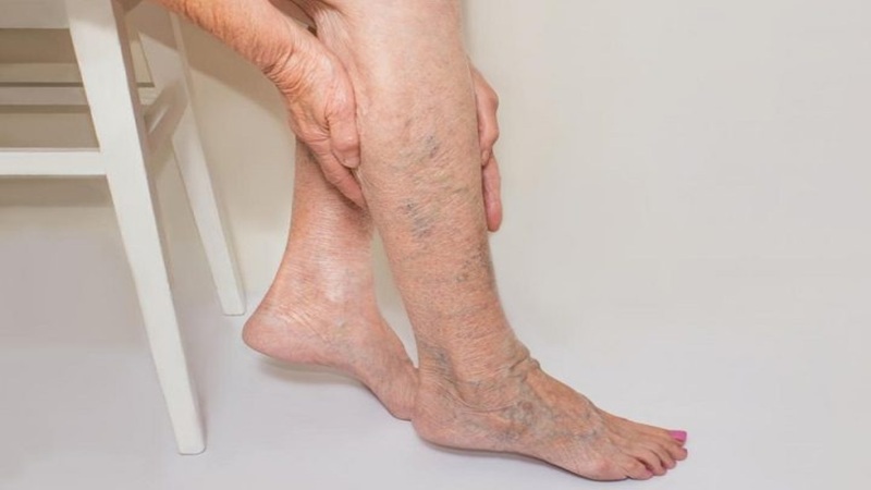 رابطه بین چاقی و واریس | دکتر مهرداد طاهریون (بهترین متخصص واریس اصفهان - متخصص قلب اصفهان)