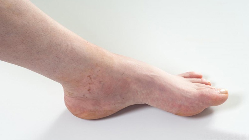 مدیریت درد واریس | بهترین متخصص واریس اصفهان - متخصص قلب اصفهان | دکتر مهرداد طاهریون