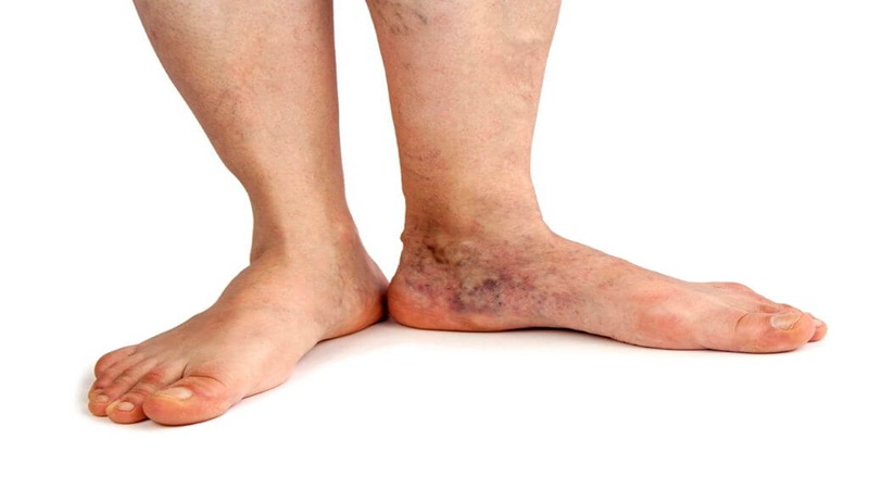 علائم شایع واریس | بهترین متخصص واریس اصفهان - متخصص قلب اصفهان | دکتر مهرداد طاهریون