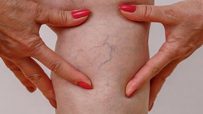 عوامل خطر برای بروز واریس | بهترین متخصص واریس اصفهان - متخصص قلب اصفهان | دکتر مهرداد طاهریون