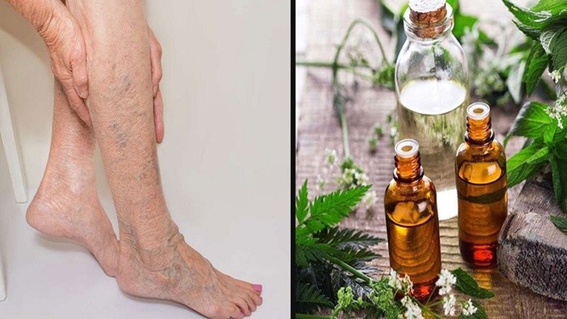 درمان‌های غیرجراحی برای واریس | بهترین متخصص واریس اصفهان - متخصص قلب اصفهان | دکتر مهرداد طاهریون